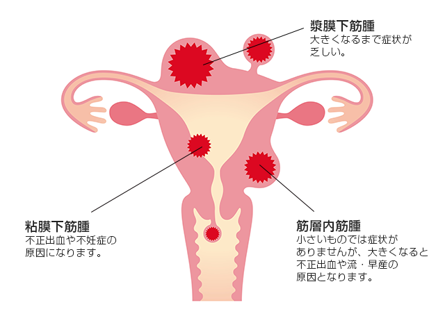 子宮筋腫 診療案内 目黒区の産科 婦人科 都立大レディースクリニック